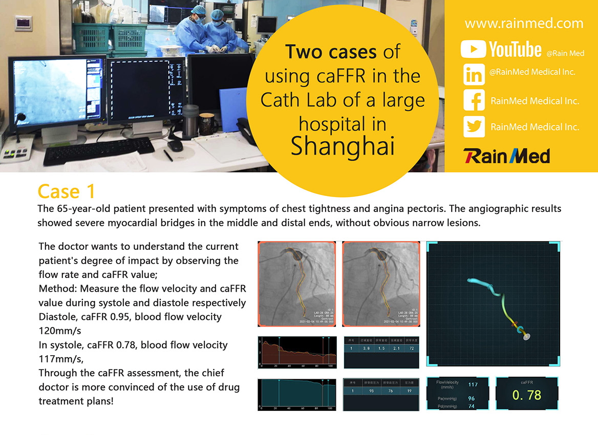Two cases of using caFFR in the Cath Lab of a large hospital in Shanghai